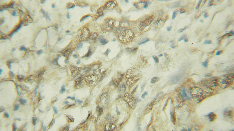 Immunohistochemical of paraffin-embedded human pancreas cancer using Catalog No:111496(HNF1B antibody) at dilution of 1:50 (under 10x lens)