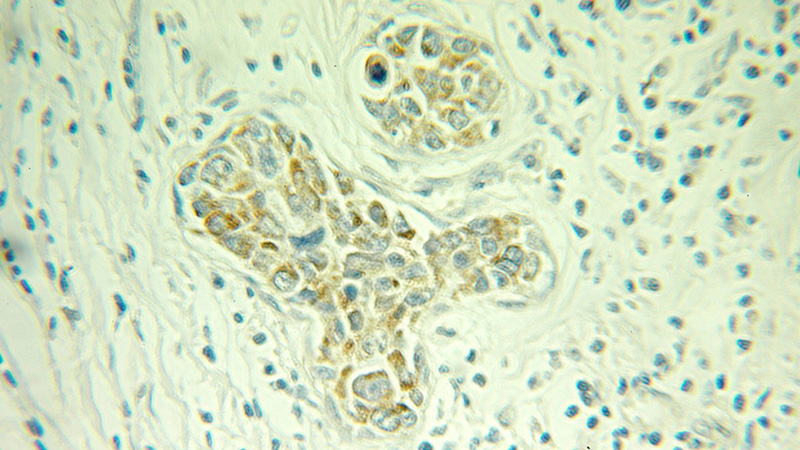 Immunohistochemical of paraffin-embedded human breast cancer using Catalog No:113480(PACSIN3 antibody) at dilution of 1:100 (under 25x lens)