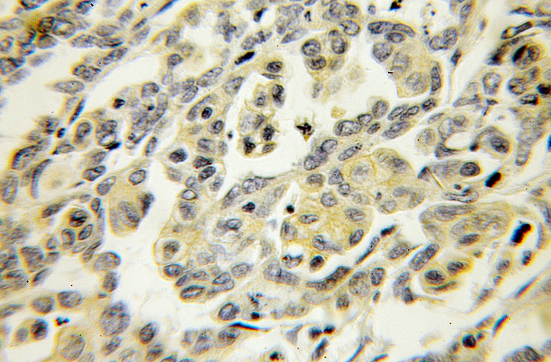 Immunohistochemical of paraffin-embedded human ovary tumor using Catalog No:114330(rPTPσ antibody) at dilution of 1:100 (under 10x lens)