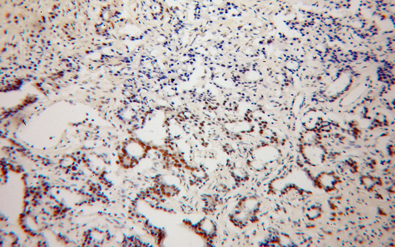 Immunohistochemical of paraffin-embedded human gliomas using Catalog No:113453(NXF3 antibody) at dilution of 1:50 (under 10x lens)
