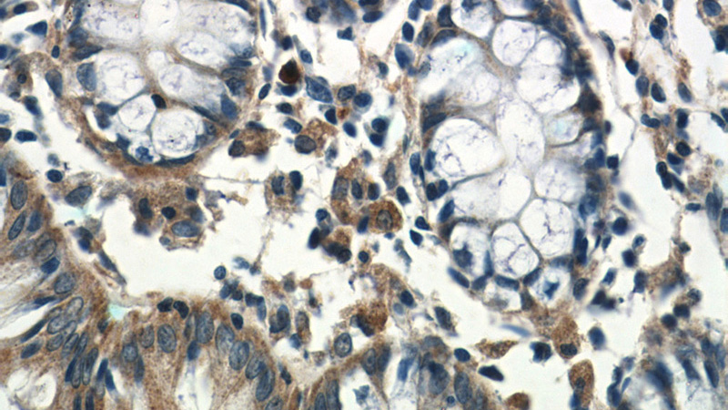 Immunohistochemistry of paraffin-embedded human colon tissue slide using Catalog No:116440(TSPAN1 Antibody) at dilution of 1:50 (under 40x lens)