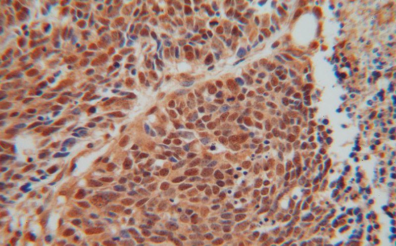 Immunohistochemical of paraffin-embedded human lung cancer using Catalog No:115121(SEPT7 antibody) at dilution of 1:100 (under 40x lens)