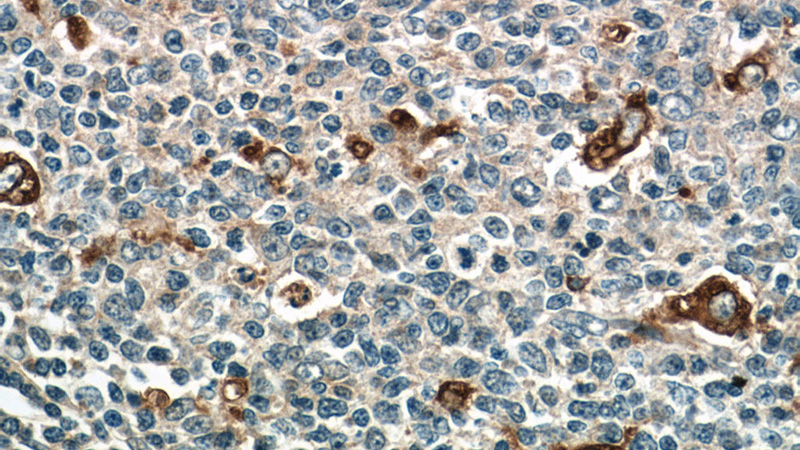 Immunohistochemistry of paraffin-embedded human tonsillitis tissue slide using Catalog No:109134(CD68 Antibody) at dilution of 1:50 (under 40x lens)