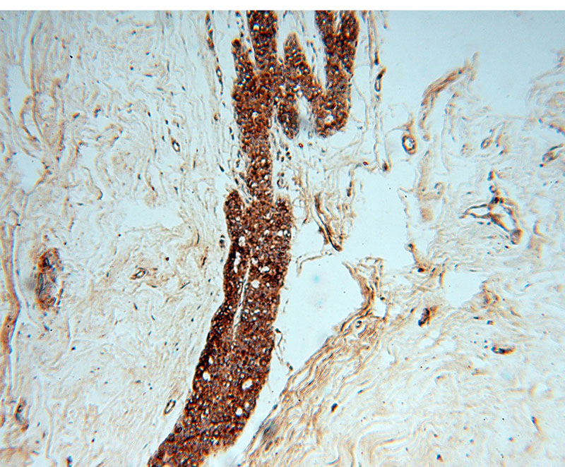 Immunohistochemical of paraffin-embedded human colon cancer using Catalog No:109293(CHST12 antibody) at dilution of 1:50 (under 10x lens)