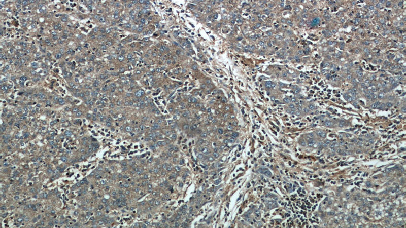 Immunohistochemical of paraffin-embedded human liver cancer using Catalog No:109083(CCT4 antibody) at dilution of 1:50 (under 10x lens)