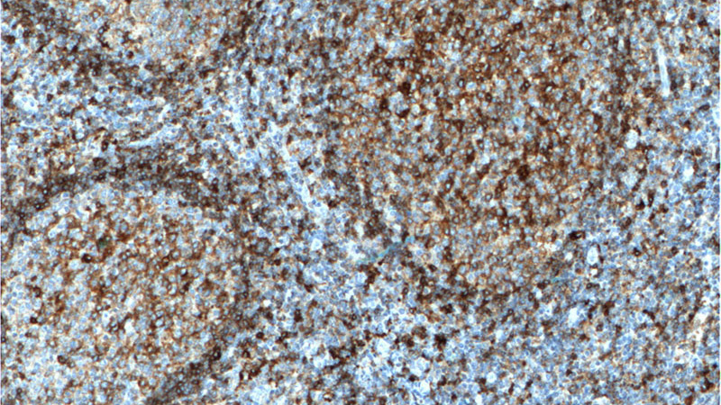 Immunohistochemistry of paraffin-embedded human tonsillitis tissue slide using Catalog No:111422(HLA-DQA1 Antibody) at dilution of 1:200 (under 10x lens). heat mediated antigen retrieved with Tris-EDTA buffer(pH9).
