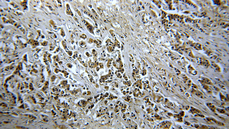 Immunohistochemical of paraffin-embedded human breast cancer using Catalog No:109298(CHST3 antibody) at dilution of 1:50 (under 10x lens)