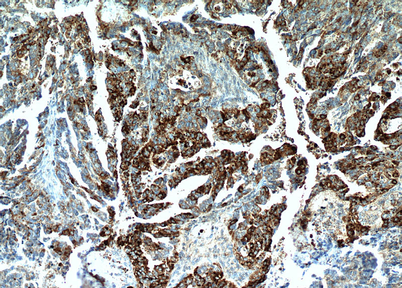 Immunohistochemical of paraffin-embedded human ovary tumor using Catalog No:109499(COX7A2L antibody) at dilution of 1:50 (under 10x lens)