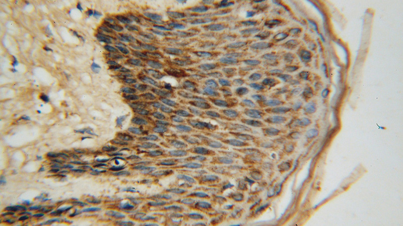 Immunohistochemical of paraffin-embedded human skin cancer using Catalog No:111051(GOT2 antibody) at dilution of 1:100 (under 40x lens)