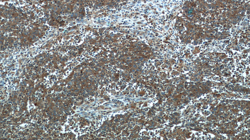 Immunohistochemistry of paraffin-embedded human colon cancer tissue slide using Catalog No:109685(CYP1B1 Antibody) at dilution of 1:50 (under 10x lens)