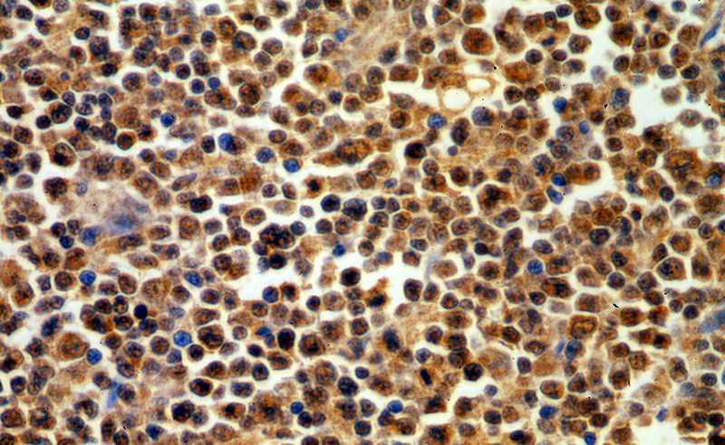 Immunohistochemical of paraffin-embedded human lymphoma using Catalog No:109972(DNTT,TDT antibody) at dilution of 1:50 (under 40x lens)