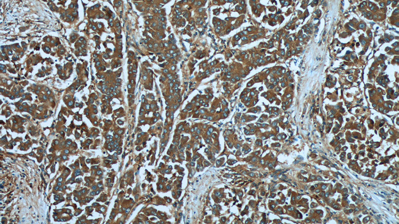 Immunohistochemistry of paraffin-embedded human liver cancer tissue slide using Catalog No:112364(MACC1 Antibody) at dilution of 1:50 (under 10x lens)
