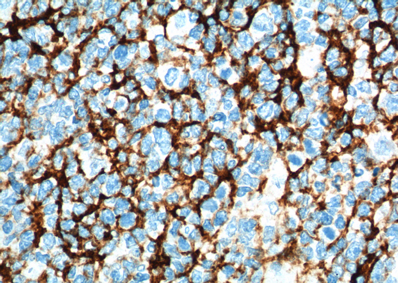 Immunohistochemistry of paraffin-embedded human tonsillitis tissue slide using Catalog No:107126(CD23,FCER2 Antibody) at dilution of 1:200 (under 40x lens). heat mediated antigen retrieved with Tris-EDTA buffer(pH9).
