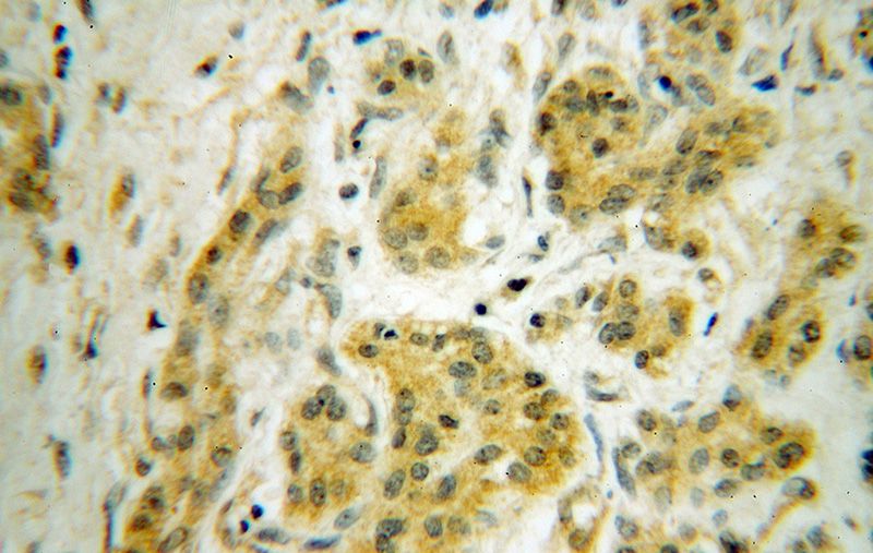 Immunohistochemical of paraffin-embedded human pancreas cancer using Catalog No:108019(ANAPC5 antibody) at dilution of 1:50 (under 40x lens)