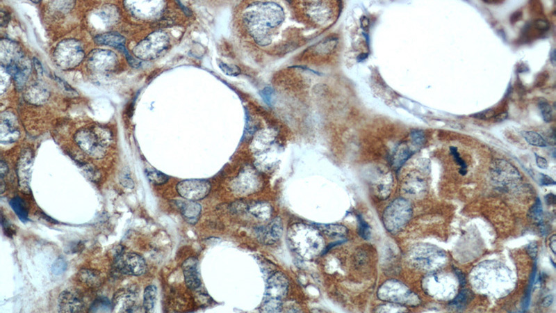 Immunohistochemical of paraffin-embedded human breast cancer using Catalog No:107605(STC2 antibody) at dilution of 1:50 (under 40x lens)