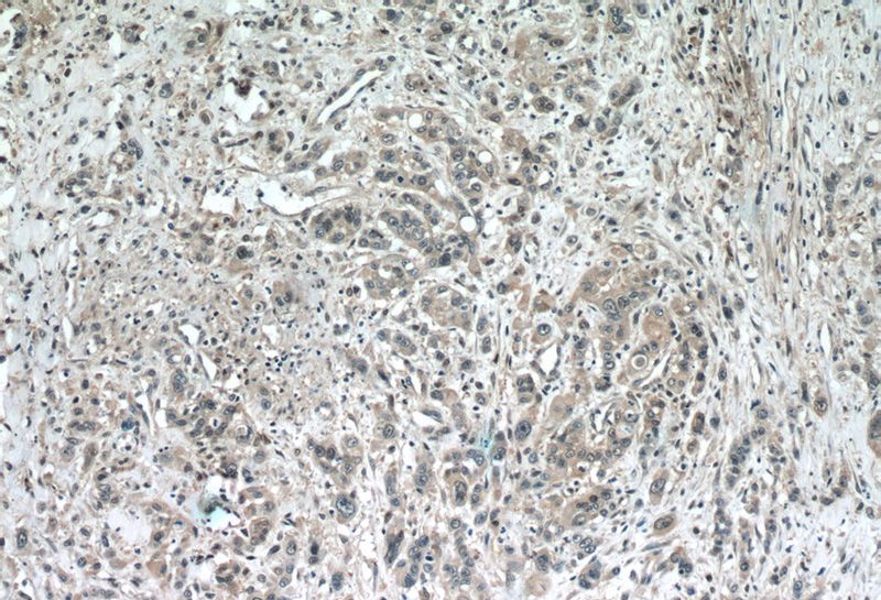 Immunohistochemistry of paraffin-embedded human stomach cancer tissue slide using Catalog No:115682(STARD8 Antibody) at dilution of 1:50 (under 10x lens)