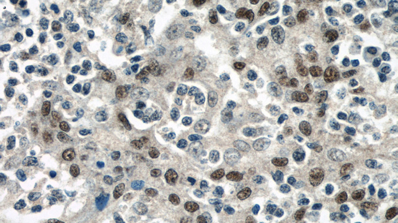 Immunohistochemical of paraffin-embedded human tonsillitis using Catalog No:113840(PITX1 antibody) at dilution of 1:50 (under 40x lens)