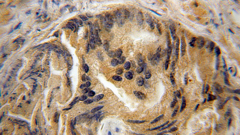 Immunohistochemical of paraffin-embedded human prostate cancer using Catalog No:115551(SPATA2 antibody) at dilution of 1:100 (under 10x lens)