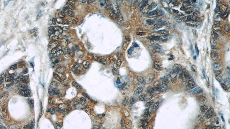 Immunohistochemical of paraffin-embedded human colon cancer using Catalog No:107645(TRIP6 antibody) at dilution of 1:50 (under 40x lens)