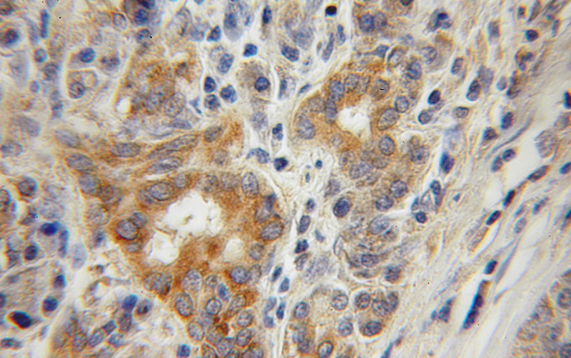 Immunohistochemical of paraffin-embedded human pancreas cancer using Catalog No:109721(CTDSP2 antibody) at dilution of 1:50 (under 10x lens)