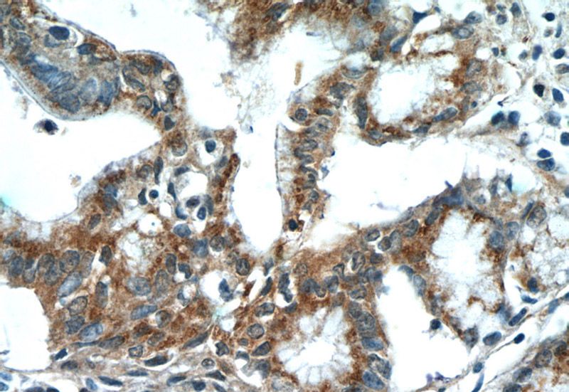 Immunohistochemistry of paraffin-embedded human pancreas cancer tissue slide using Catalog No:115648(SPRY2 Antibody) at dilution of 1:50 (under 40x lens)