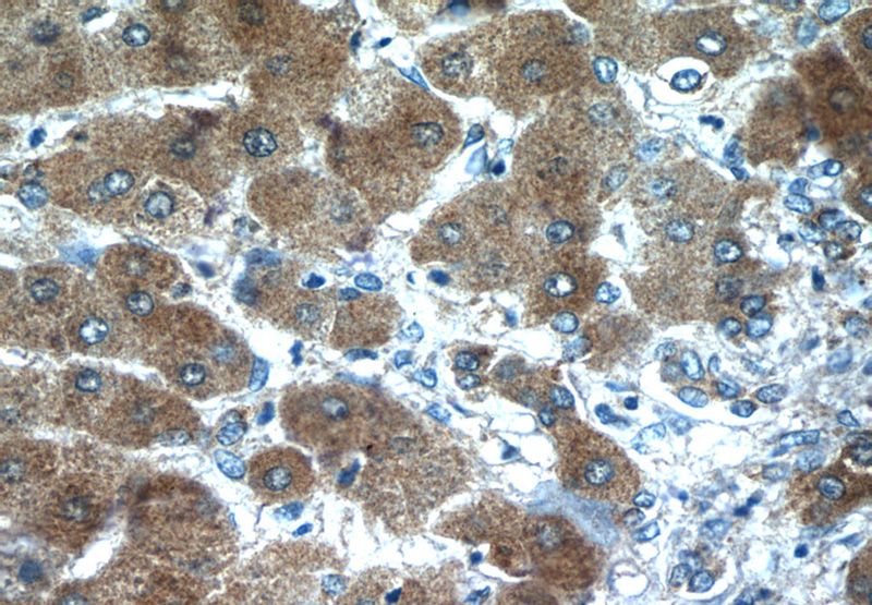 Immunohistochemistry of paraffin-embedded human hepatocirrhosis tissue slide using Catalog No:108053(AGT Antibody) at dilution of 1:50 (under 40x lens)