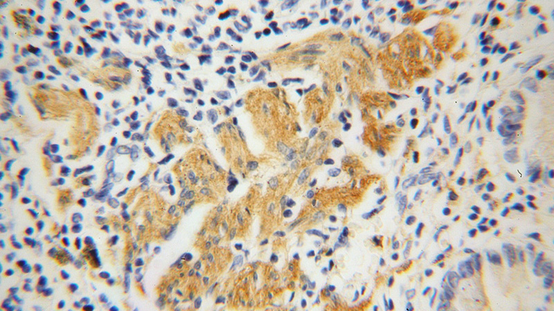 Immunohistochemical of paraffin-embedded human colon cancer using Catalog No:116395(TRMT1 antibody) at dilution of 1:50 (under 40x lens)