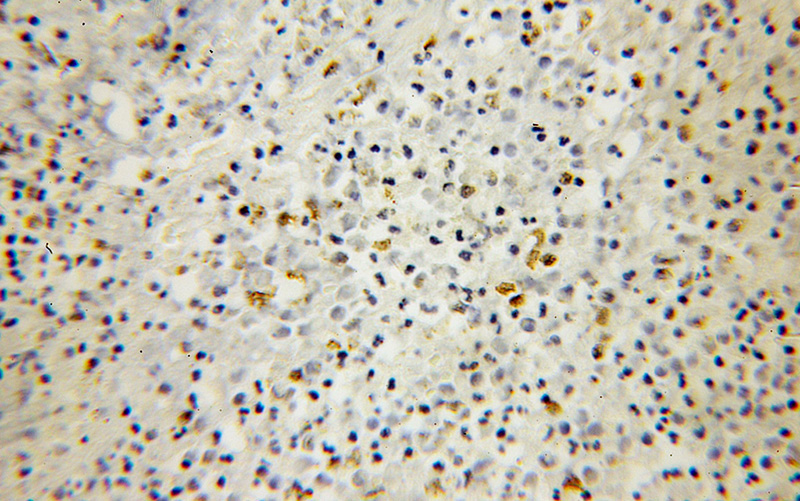 Immunohistochemical of paraffin-embedded human colon cancer using Catalog No:116512(UBD antibody) at dilution of 1:100 (under 10x lens)