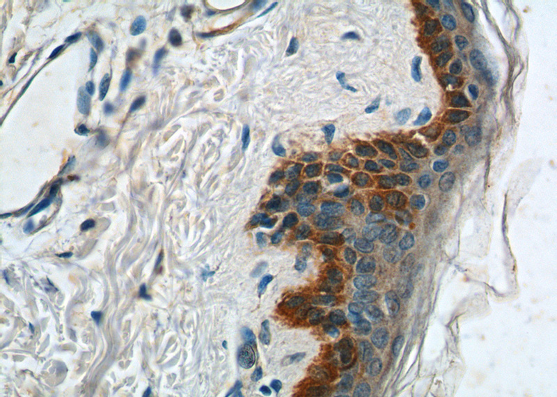 Immunohistochemistry of paraffin-embedded human skin tissue slide using Catalog No:109793(KRT14 Antibody) at dilution of 1:200 (under 40x lens).