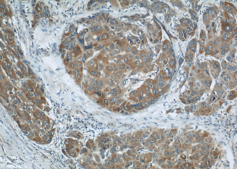 Immunohistochemical of paraffin-embedded human liver cancer using Catalog No:112670(BBS13 antibody) at dilution of 1:50 (under 10x lens)