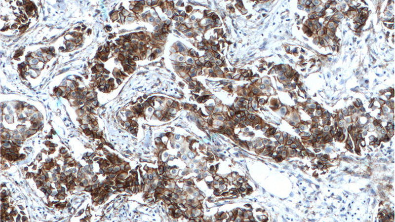 Immunohistochemistry of paraffin-embedded human breast ductal carcinoma tissue slide using Catalog No:107441 (CTNND1 Antibody) at dilution of 1:200 (under 10x lens). Heat mediated antigen retrieved with Tris-EDTA buffer(pH9).
