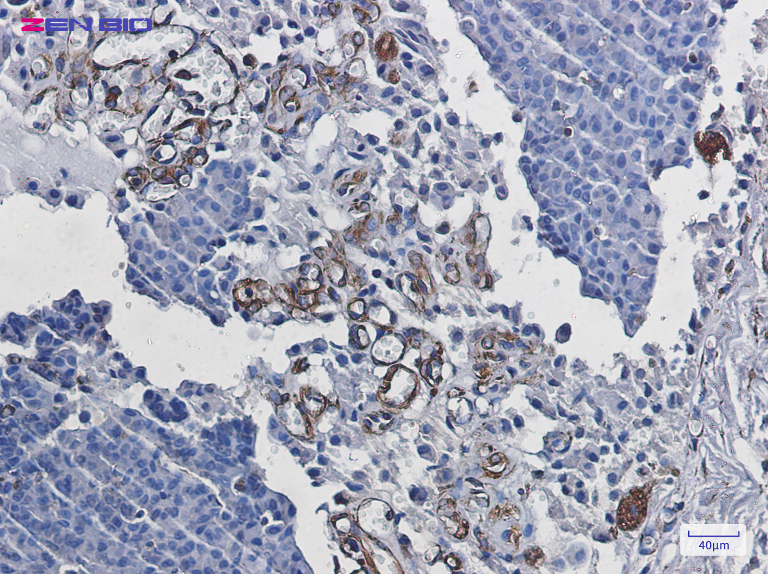 Immunohistochemistry of Staufen in paraffin-embedded Human breast cancer tissue using Staufen Rabbit pAb at dilution 1/50