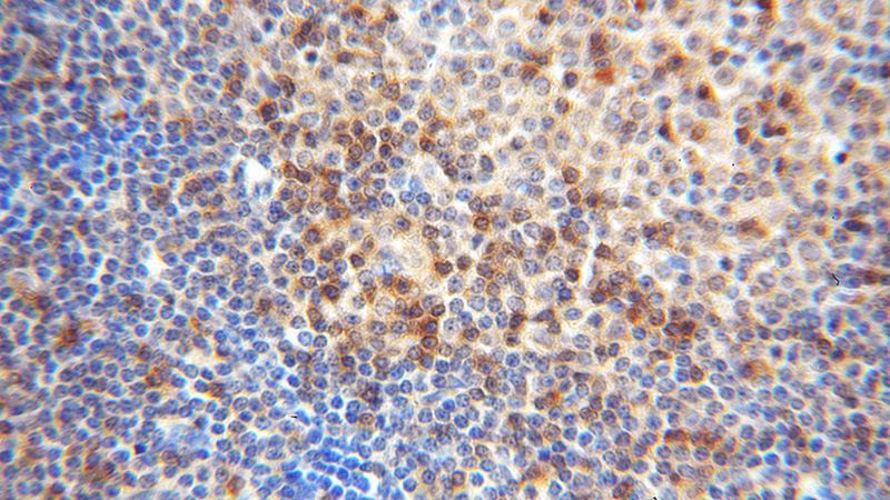 Immunohistochemical of paraffin-embedded human lymphoma using Catalog No:110050(DOK2 antibody) at dilution of 1:100 (under 40x lens)