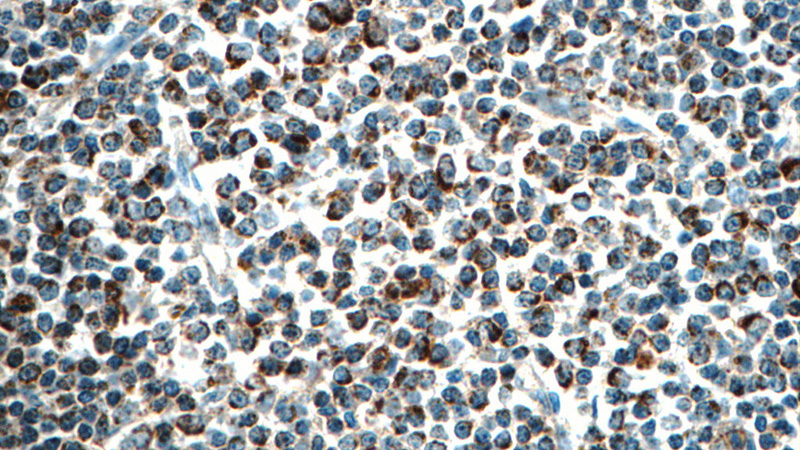 Immunohistochemistry of paraffin-embedded human lymphoma tissue slide using Catalog No:108854(CARD11 Antibody) at dilution of 1:50 (under 40x lens)
