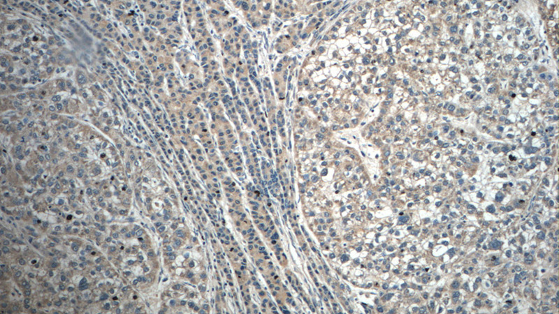 Immunohistochemistry of paraffin-embedded human liver cancer tissue slide using Catalog No:108739(C6 Antibody) at dilution of 1:50 (under 10x lens)