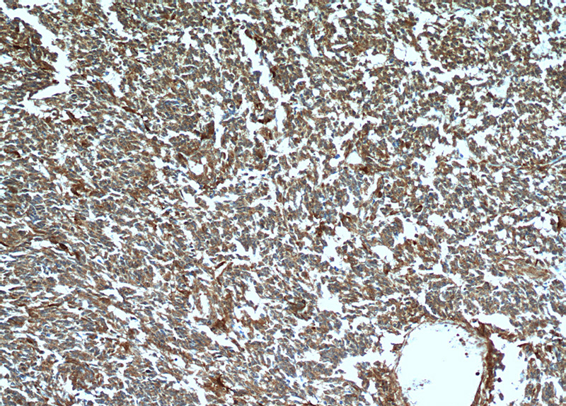 Immunohistochemical of paraffin-embedded human gliomas using Catalog No:110443(FABP7 antibody) at dilution of 1:50 (under 10x lens)