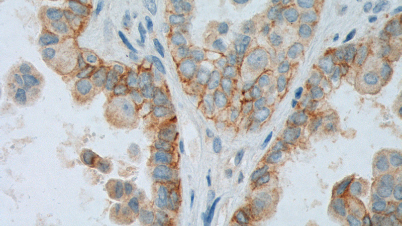 Immunohistochemistry of paraffin-embedded human ovary tumor tissue slide using Catalog No:109127(CD47 Antibody) at dilution of 1:200 (under 40x lens). heat mediated antigen retrieved with Tris-EDTA buffer(pH9).