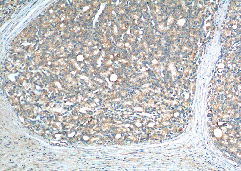 Immunohistochemistry of paraffin-embedded human prostate cancer tissue slide using Catalog No:116738(VEGFC Antibody) at dilution of 1:200 (under 10x lens).