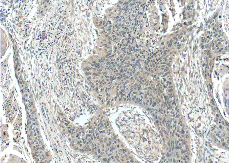 Immunohistochemistry of paraffin-embedded human cervical cancer tissue slide using Catalog No:112314(LRCH1 Antibody) at dilution of 1:50 (under 10x lens)