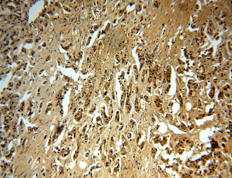 Immunohistochemical of paraffin-embedded human breast cancer using Catalog No:112698(MMP13 antibody) at dilution of 1:50 (under 10x lens)