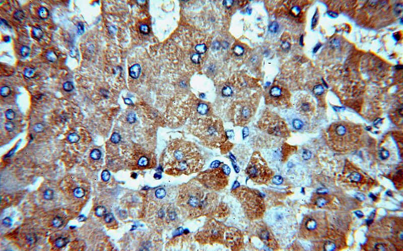 Immunohistochemical of paraffin-embedded human hepatocirrhosis using Catalog No:108941(CBR4 antibody) at dilution of 1:50 (under 40x lens)