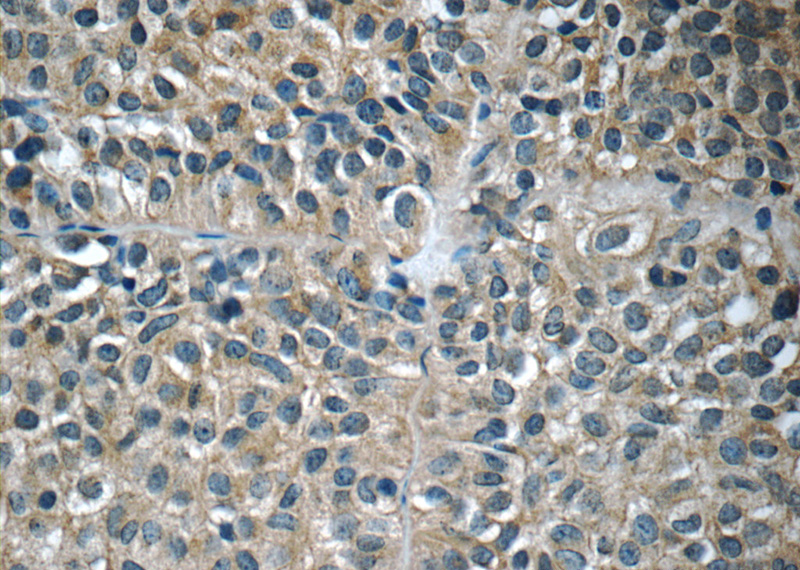 Immunohistochemistry of paraffin-embedded human pituitary adenoma tissue slide using Catalog No:111219(GH1 Antibody) at dilution of 1:50 (under 40x lens)