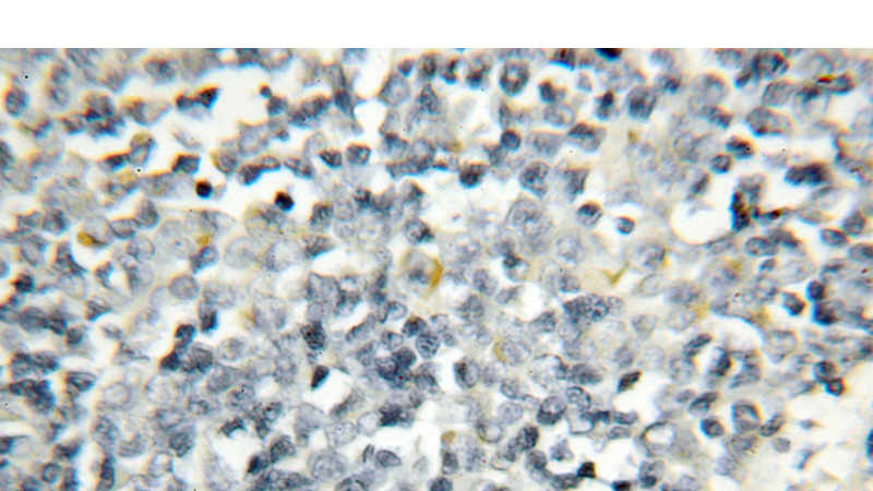 Immunohistochemical of paraffin-embedded human lymphoma using Catalog No:114319(PTPN22 antibody) at dilution of 1:50 (under 10x lens)