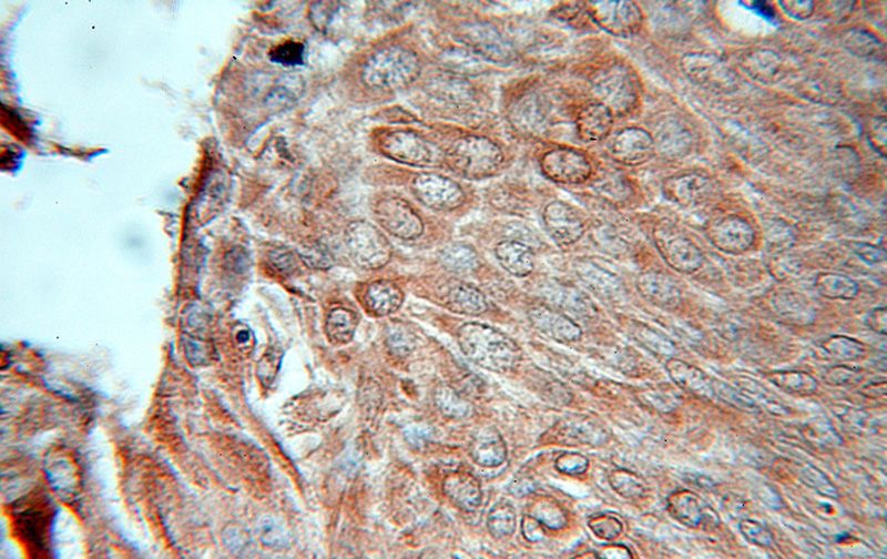 Immunohistochemical of paraffin-embedded human lung cancer using Catalog No:114431(RAB32 antibody) at dilution of 1:50 (under 10x lens)
