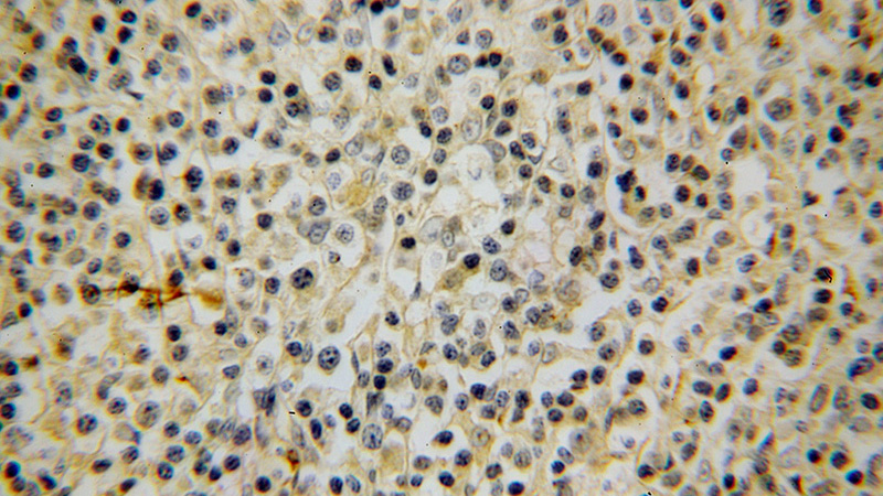 Immunohistochemical of paraffin-embedded human lymphoma using Catalog No:107755(ACVRL1 antibody) at dilution of 1:50 (under 40x lens)