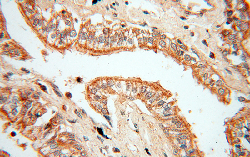 Immunohistochemical of paraffin-embedded human lung cancer using Catalog No:112382(MAGEA6 antibody) at dilution of 1:50 (under 40x lens)