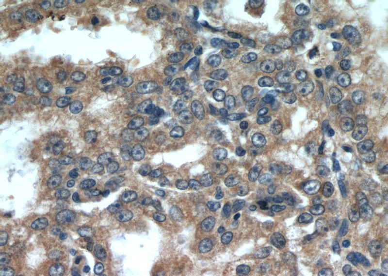 Immunohistochemical of paraffin-embedded human prostate cancer using Catalog No:115725(STK4 antibody) at dilution of 1:50 (under 40x lens)