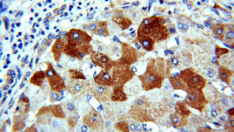 Immunohistochemical of paraffin-embedded human hepatocirrhosis using Catalog No:111326(H6PD antibody) at dilution of 1:100 (under 40x lens)
