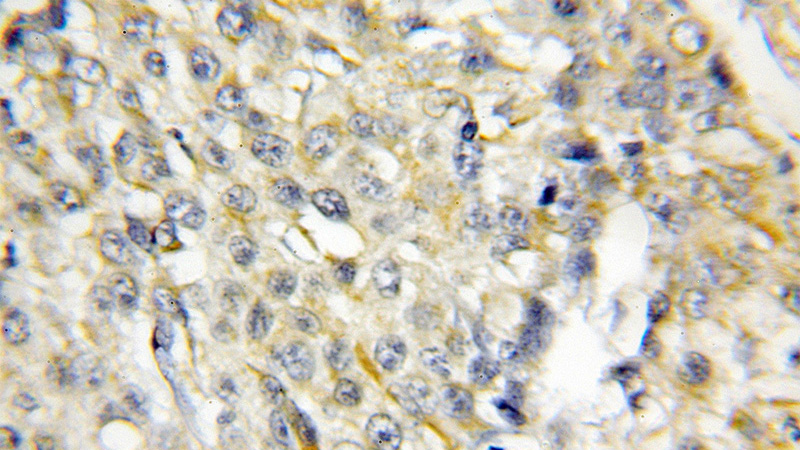 Immunohistochemical of paraffin-embedded human lung cancer using Catalog No:114508(RACK1; GNB2L1 antibody) at dilution of 1:50 (under 10x lens)