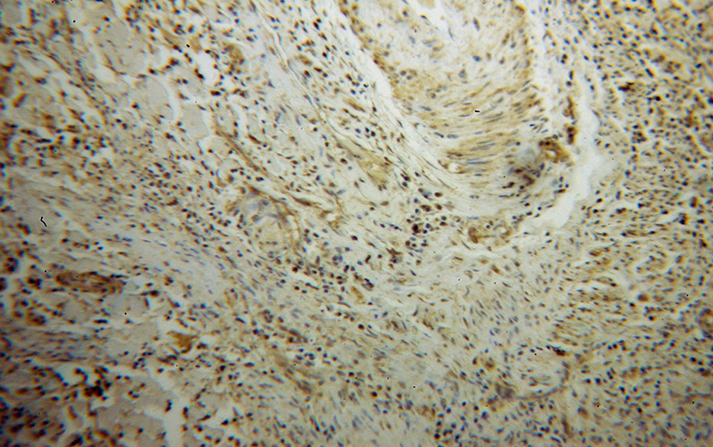 Immunohistochemical of paraffin-embedded human cervical cancer using Catalog No:115989(TAF7 antibody) at dilution of 1:100 (under 10x lens)